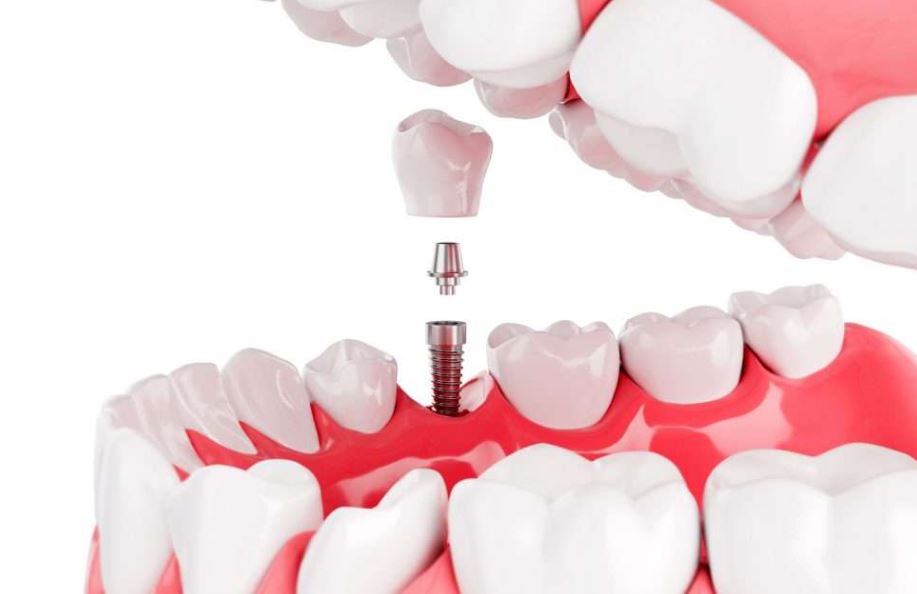 Average Price of Full Mouth Dental Implants