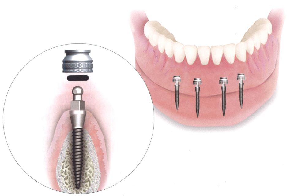 8 Signs That You Need Dental Implants