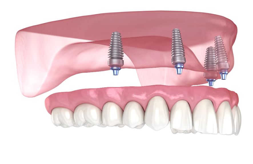 All-on-4 Dental Implants Cost with Insurance
