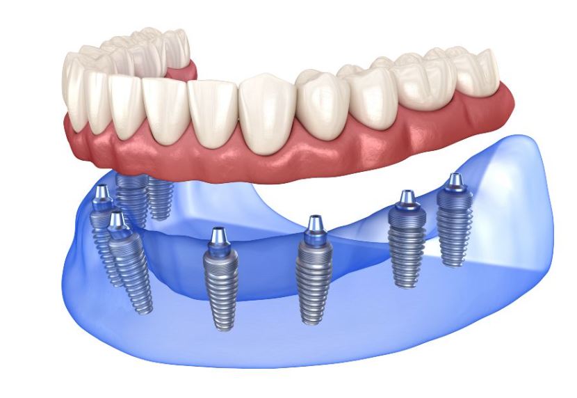 All on 8 Implants