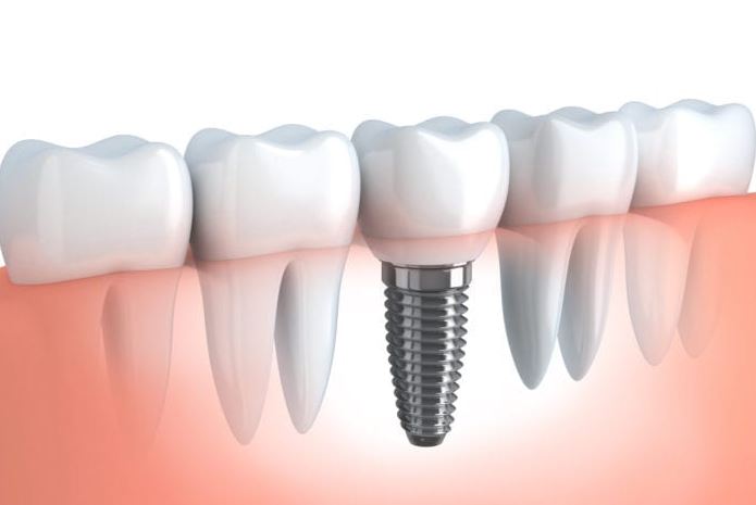  Full Mouth Dental Implants 