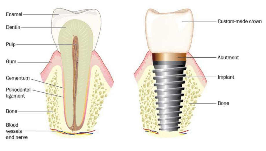 Failure Rate of Dental Implants