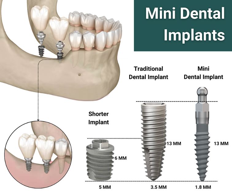 What are mini Dental Implants Cost in the Pros and the Cons