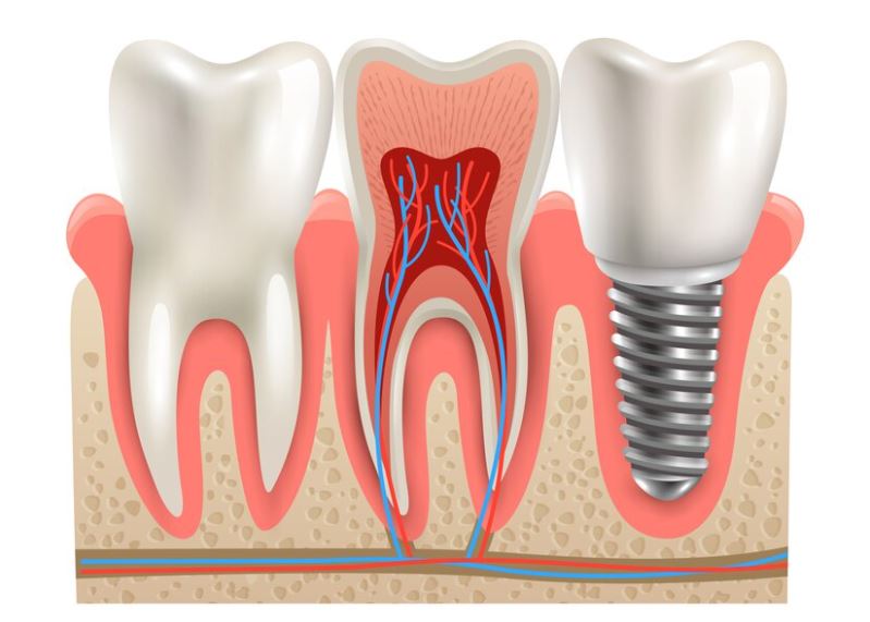 Pros and Cons of Full Mouth Dental Implants